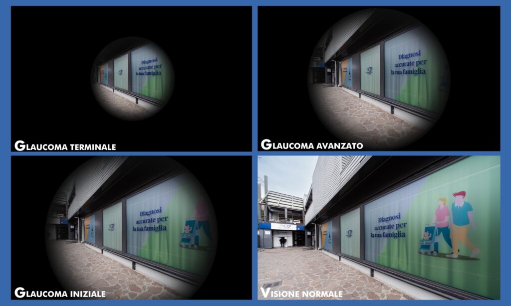 Glaucoma prima e dopo